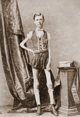 «Живой скелет». Человек, который весил меньше ребенка.