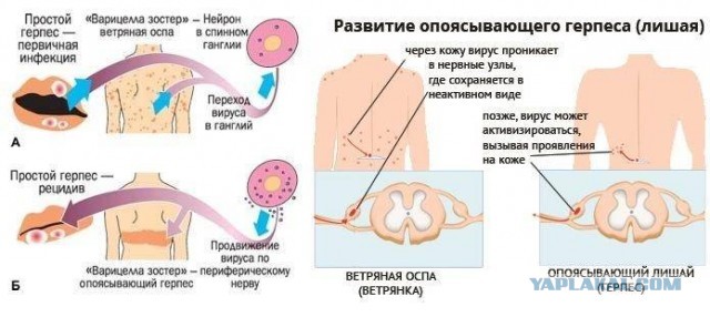 Заболел ветрянкой в 38 лет. Мне капец?