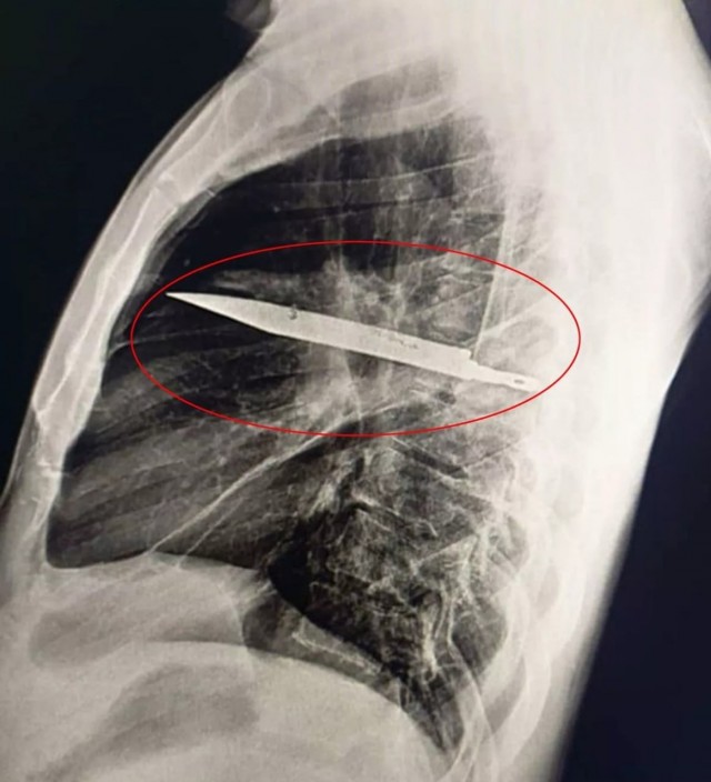 В Танзании мужчина 8 лет жил с ножом в груди и узнал об этом лишь на медосмотре