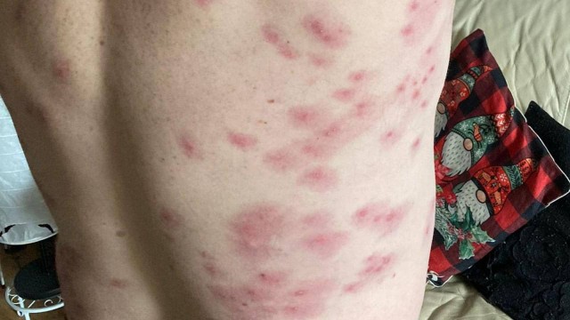 «Я чувствовал их в своих брюках. Они были везде»: мужчина выжил после того, как его 240 раз укусили осы
