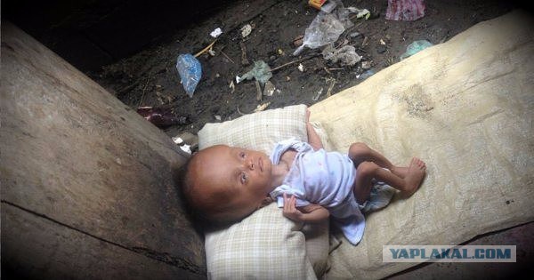 Женщина из гуманитарной миссии забрала девочку с гидроцефалией у мамаши на Гаити.