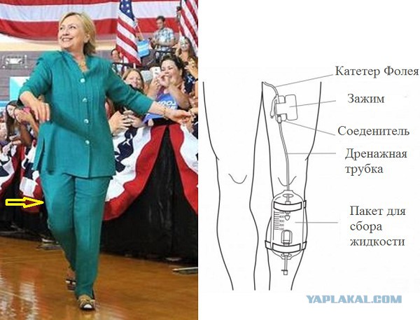 Хиллари носит мочеприёмник (катетер) прикреплённый к ноге