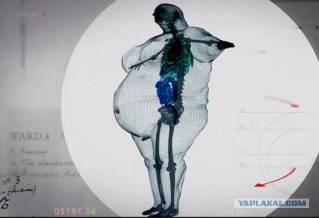 Рентгеновский снимок тела 400-кило-го мужчины