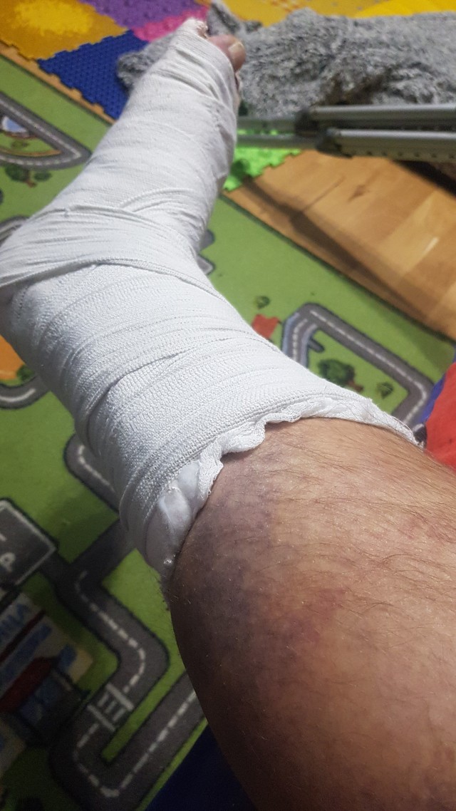 Как я сломал руку и ногу, ну и про нашу доблестную травматологию