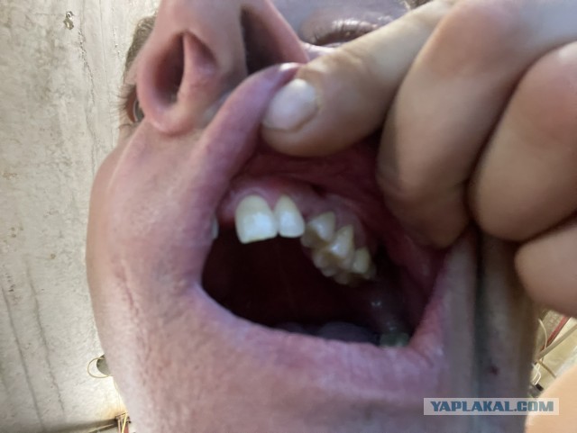 Сага о стоматологии. Глава 5. Что делать если образовалась дырка между носом и ртом после удаления зуба?
