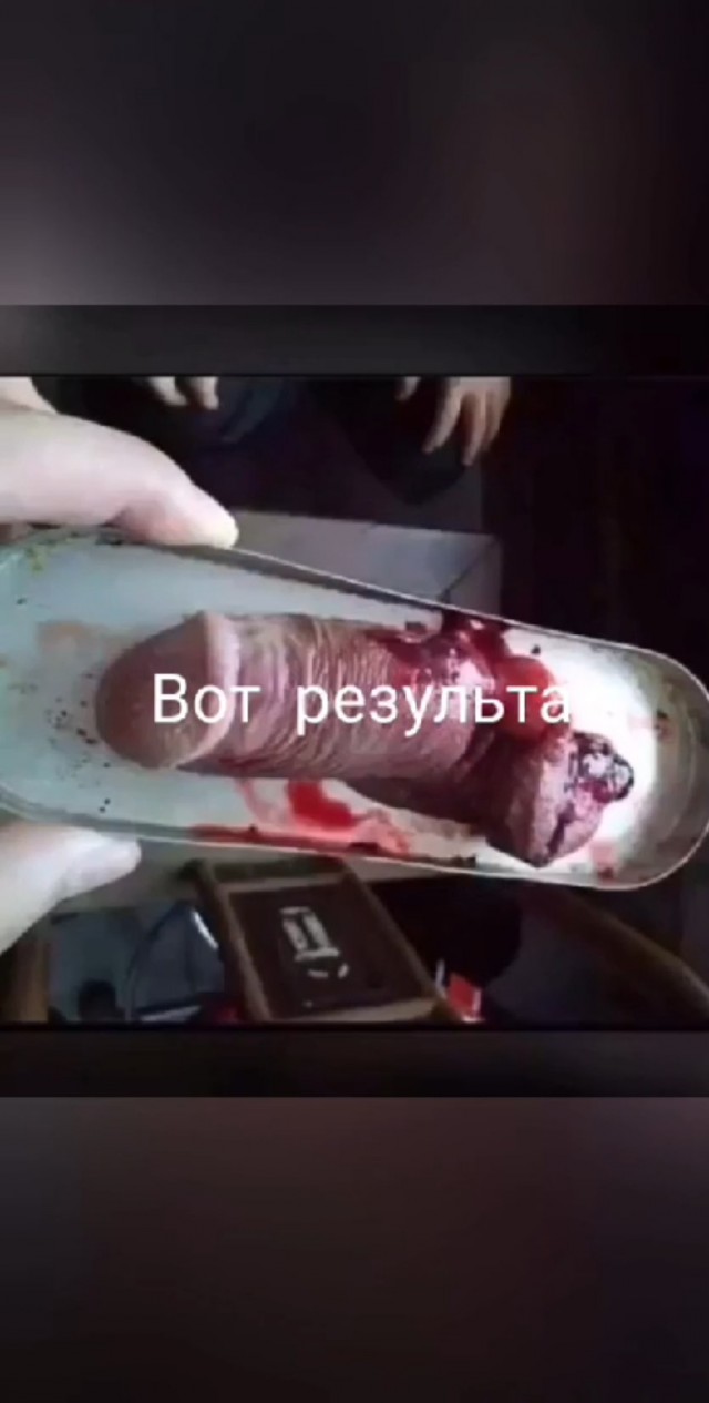Обрезали лишнего: пермяк судится с клиникой, где неудачно провели деликатную операцию