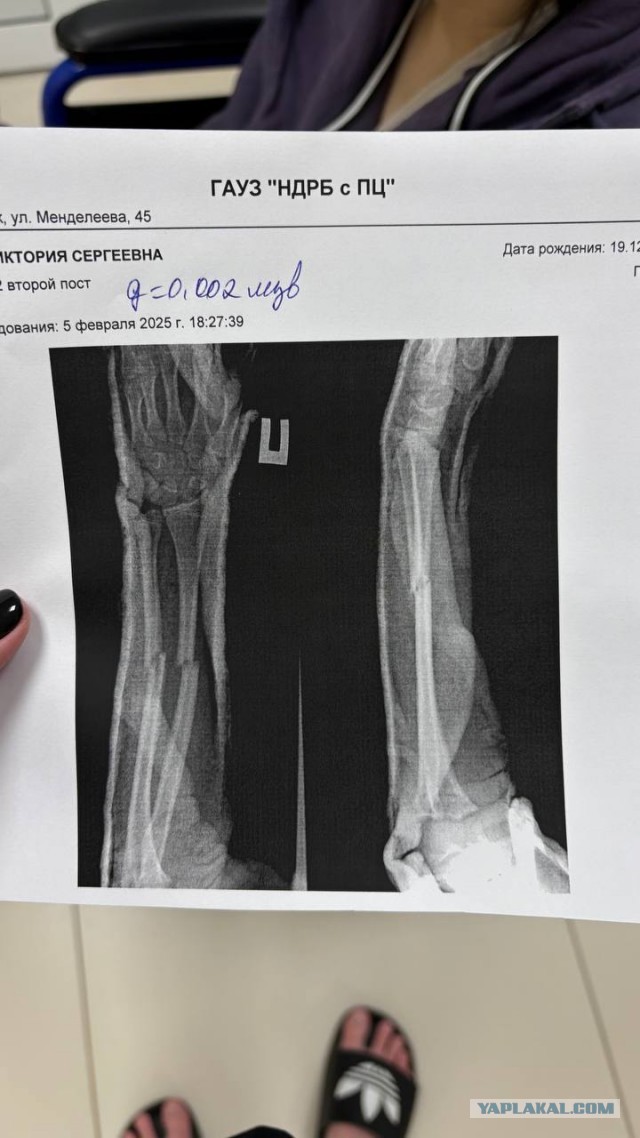 В Нижнекамске очередная "дружба народов". Девочке сломали руки.
