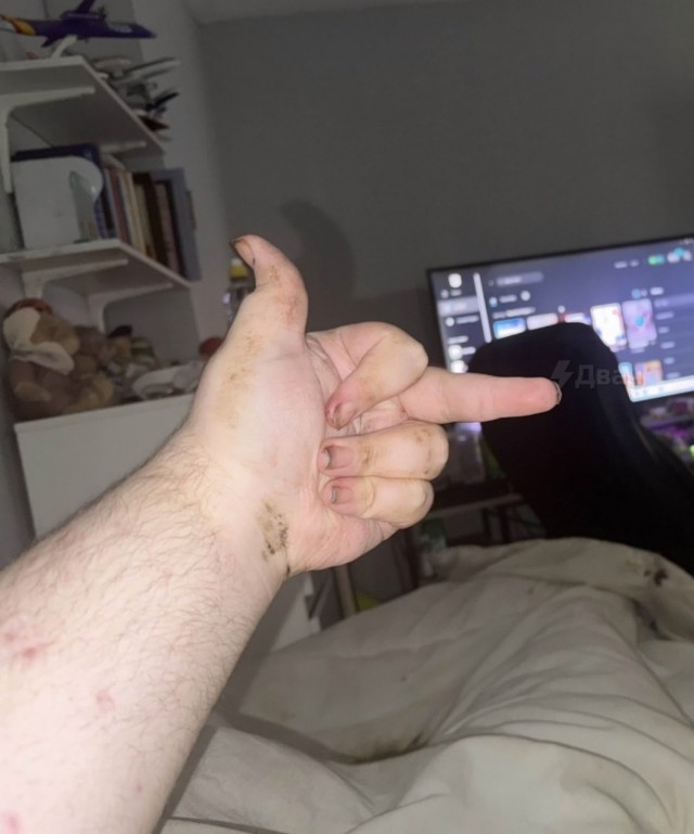 Один из лучших игроков по Fortnite — чухан, который буквально гниёт заживо