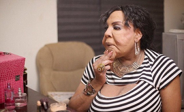 Жертва инъекций бетона показала новое лицо