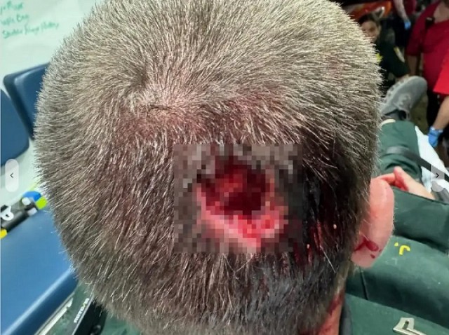 Мужчина из Флориды откусил кусок головы у полицейского на музыкальном фестивале
