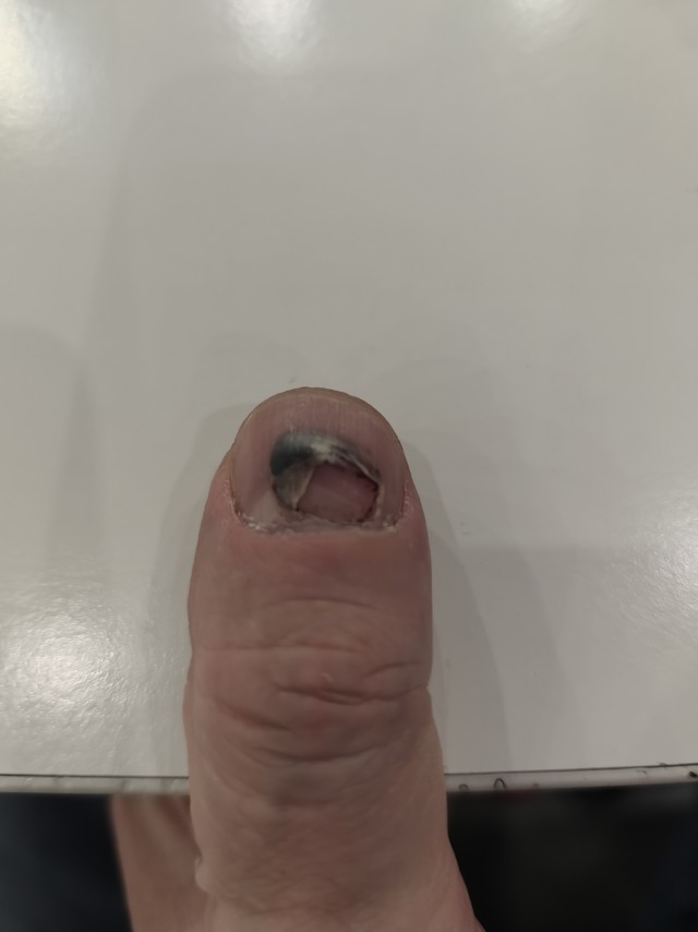 Из жизни одного пальчика