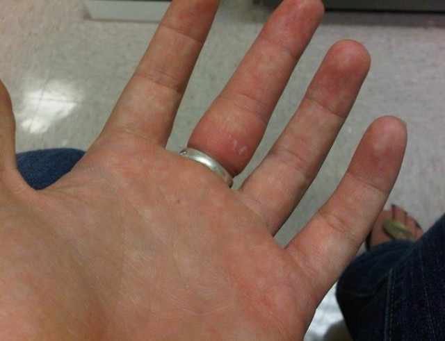 Житель Москвы 5 часов пытался снять кольцо со своего члена. Когда понял, что сам не справляется, то обратился к врачам