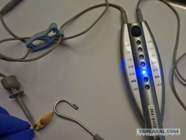 Пломбирование зубов и корневого канала