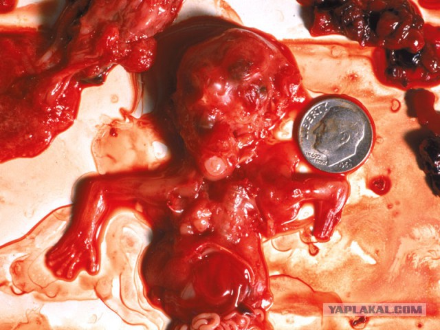 О противниках абортов.