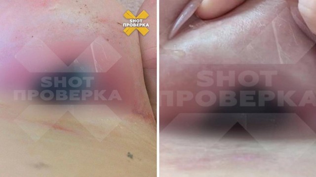 У 29-летней россиянки загноилась и порвалась грудь после установки имплантов: операцию проводил внештатный сотрудник клиники