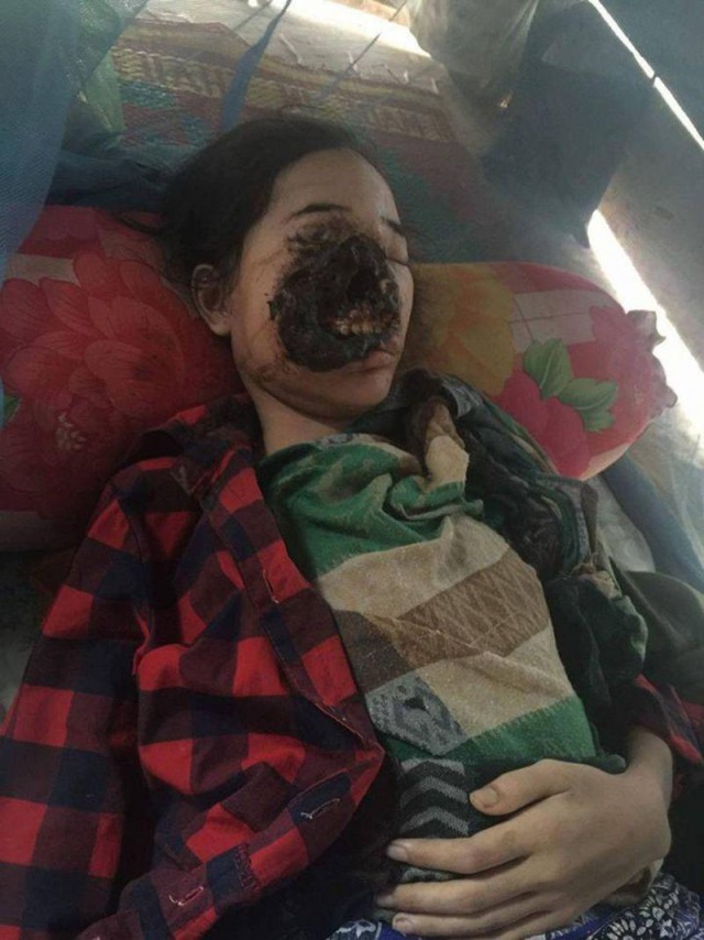 Женщина потеряла половину лица, подхватив плотоядные бактерии после удара о печь 16+