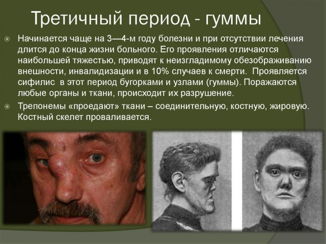 У москвички разрушился нос после того, как она постоянно в нем ковырялась