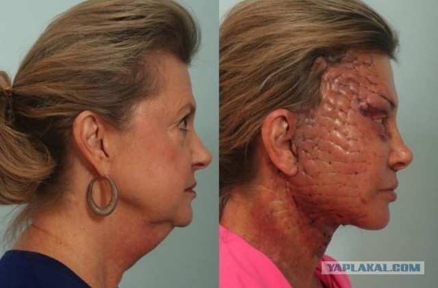 Этапы омоложения лица наглядно.