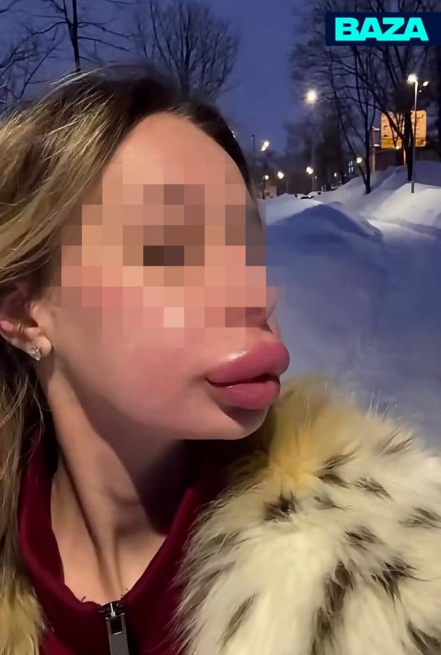 Москвичка не могла принять свою внешность и десятки раз увеличивала губы