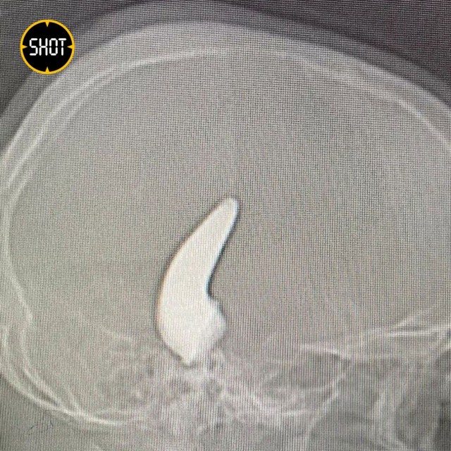 Металлический крюк из черепа мужчины достали питерские врачи и спасли ему жизнь. Операция длилась три часа.