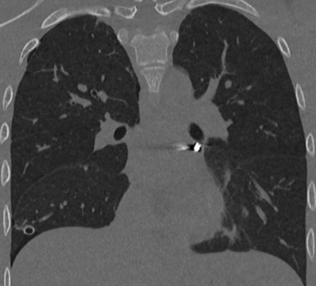 Подросток получил тяжёлое ранение во время игры с пневматикой