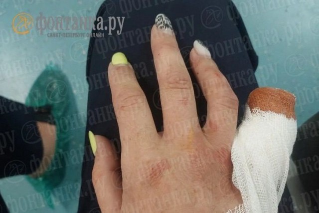 Палец уже не пришить