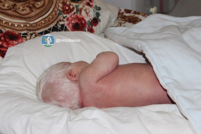 В Нижнем Тагиле родился ребёнок-альбинос