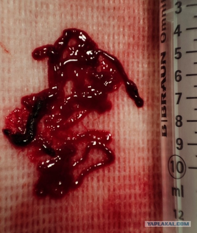 Операция по удалению тромба из артерии