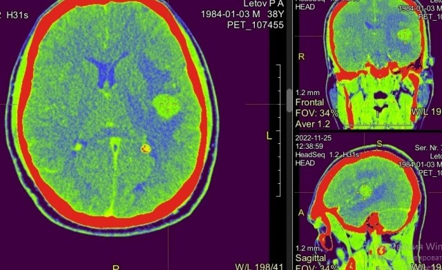 Борьба с онкологией