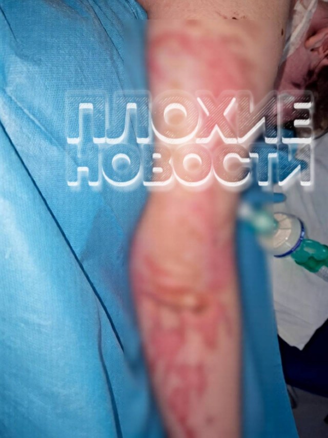 Российская туристка чуть не сгорела заживо в Кении из-за попытки персонала сжечь змею в ресторане