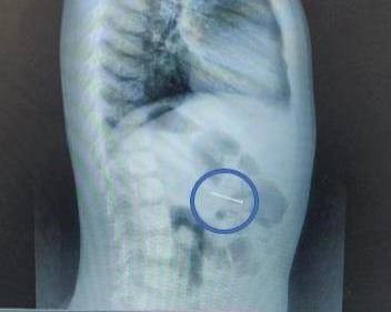 В Подмосковье 4-летний мальчик проглотил гвоздь