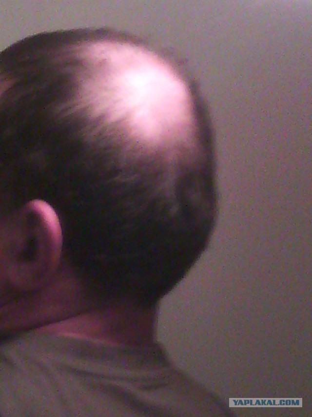 Лысение, мать его