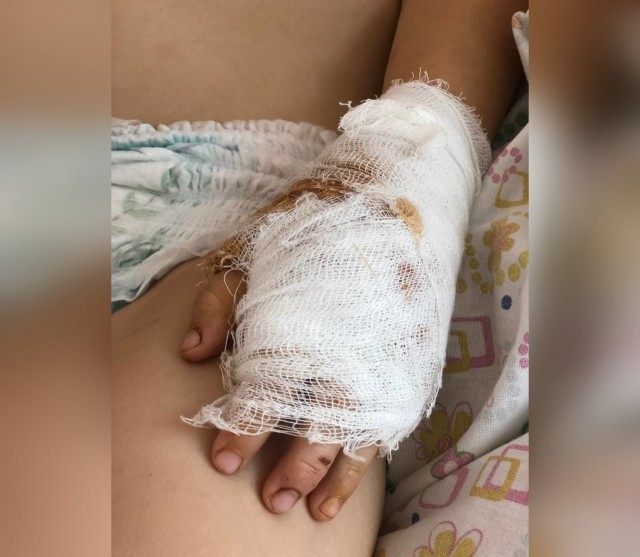 «Сухожилия разорвала на руке и на ноге, стопу сломала»