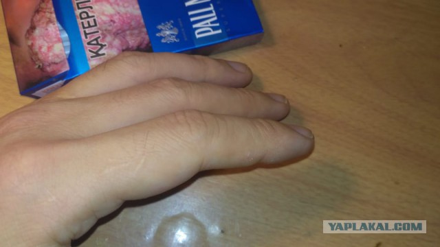 Шрамы на пальце - есть у всех? У меня даже два!