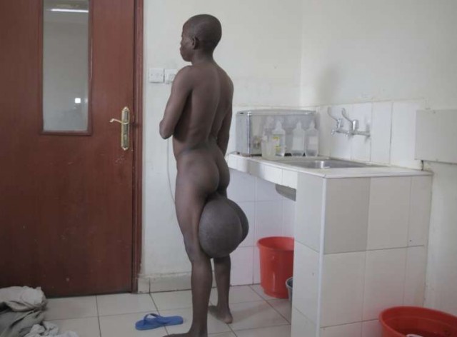 Африканский школьник попал под нож хирурга из-за слишком большого полового органа