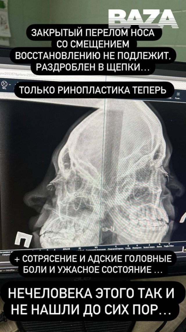 Еще одна праздничная история из Челябинска: Неадекват сломал нос промоутеру бара