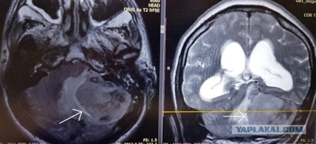 «Философия последнего шанса»: Опухоль размером с кулак удалил из мозга пациента ростовский хирург
