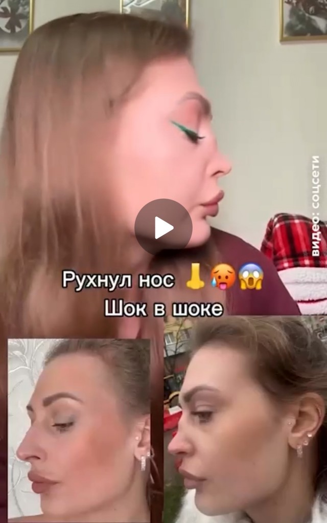 У москвички разрушился нос после того, как она постоянно в нем ковырялась