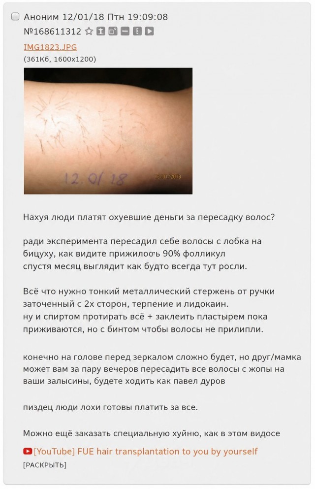 Лететь в Турцию на пересадку волос? А может лучше…