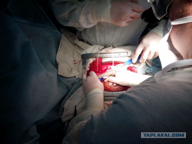 Искусственное кровообращение