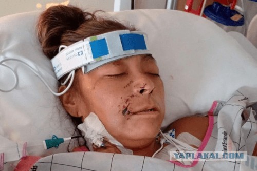 После нападения двух питбулей велосипедистке ампутировали все четыре конечности