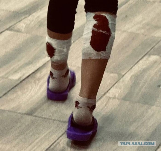 В Ивановской области покусанной собаками девочке не смогли оказать медицинскую помощь