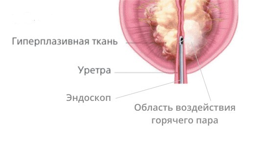 Аденому простаты научились лечить паром