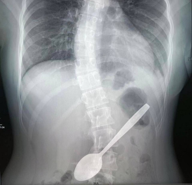 В Подмосковье 14-летняя школьница случайно проглотила 15-сантиметровую чайную ложку, пытаясь достать застрявшее в горле яблоко