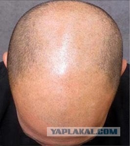 Как избавиться от лысины