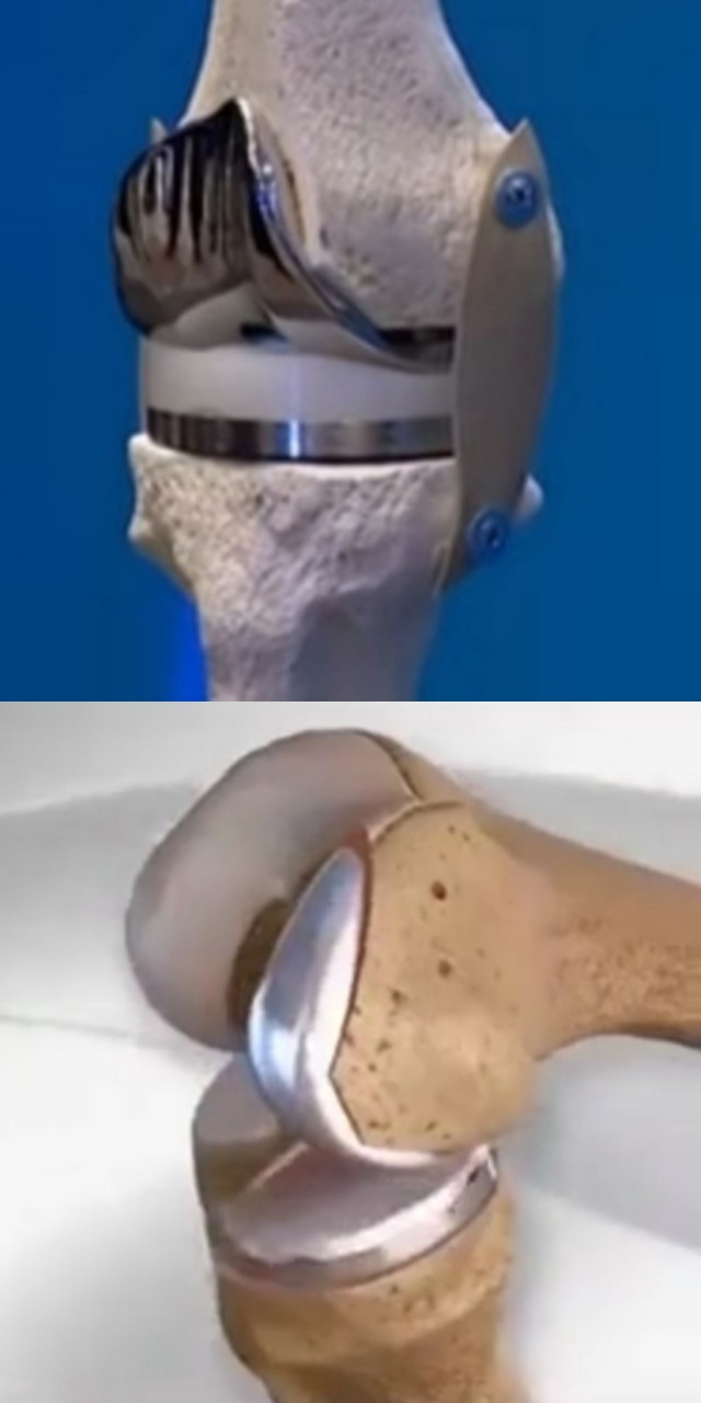 Протезирование коленного сустава