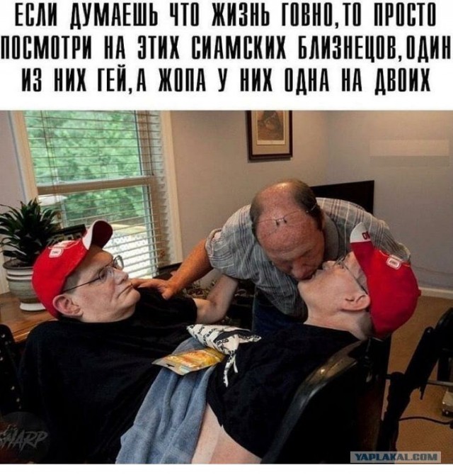 Сиамские близнецы Хенсел сообщили о беременности!