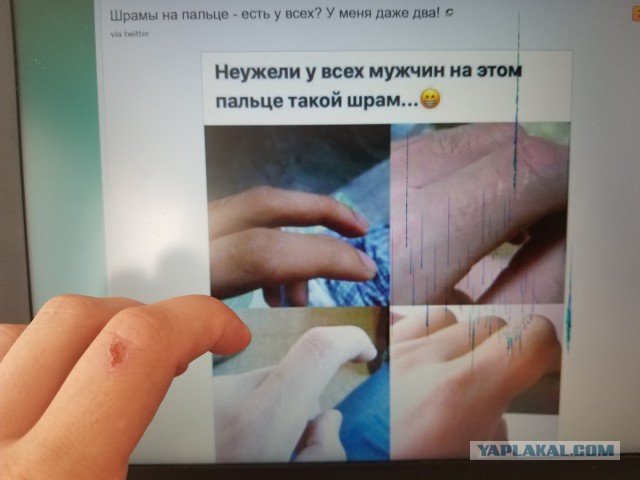 Шрамы на пальце - есть у всех? У меня даже два!