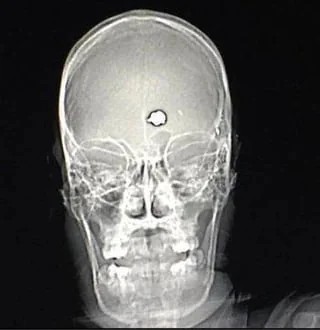 Пациент психбольницы решил покончить с собой, но случайно победил и пристрелил опухоль