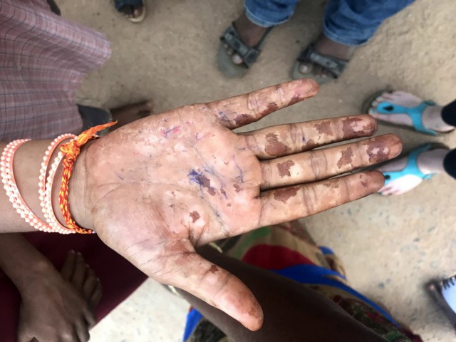 Индийские женщины платят сожженными руками за нашу любовь к кешью